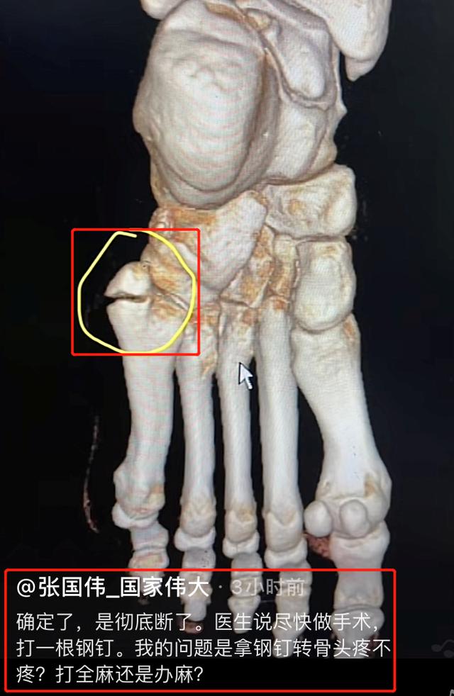 30岁张国伟因训练过猛骨折！需做手术打钢钉，脚上皮肤呈暗紫色  张国伟 第1张